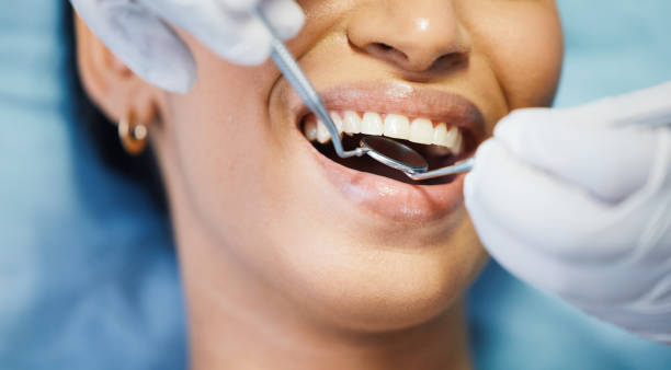 Best Emergency Wisdom Teeth Removal in Fayette, LA