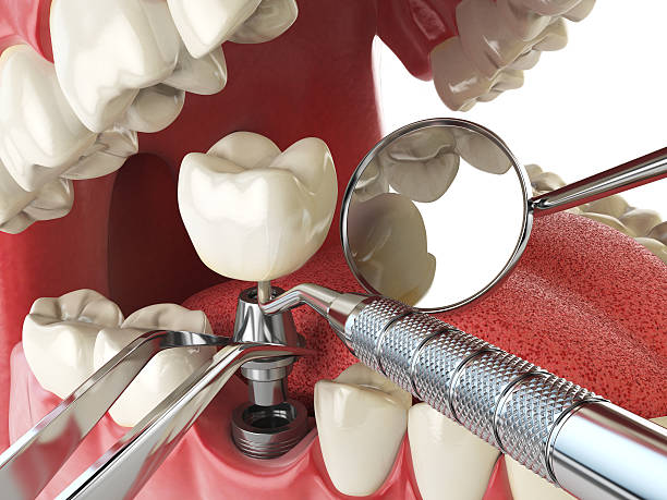 Best Emergency Broken Tooth Repair in Fayette, LA